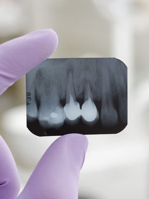 Radiografía dental Diseño de sonrisas Odontología