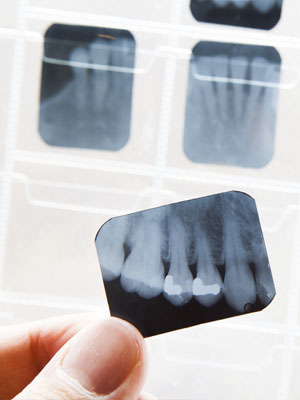 Las radiografías dentales