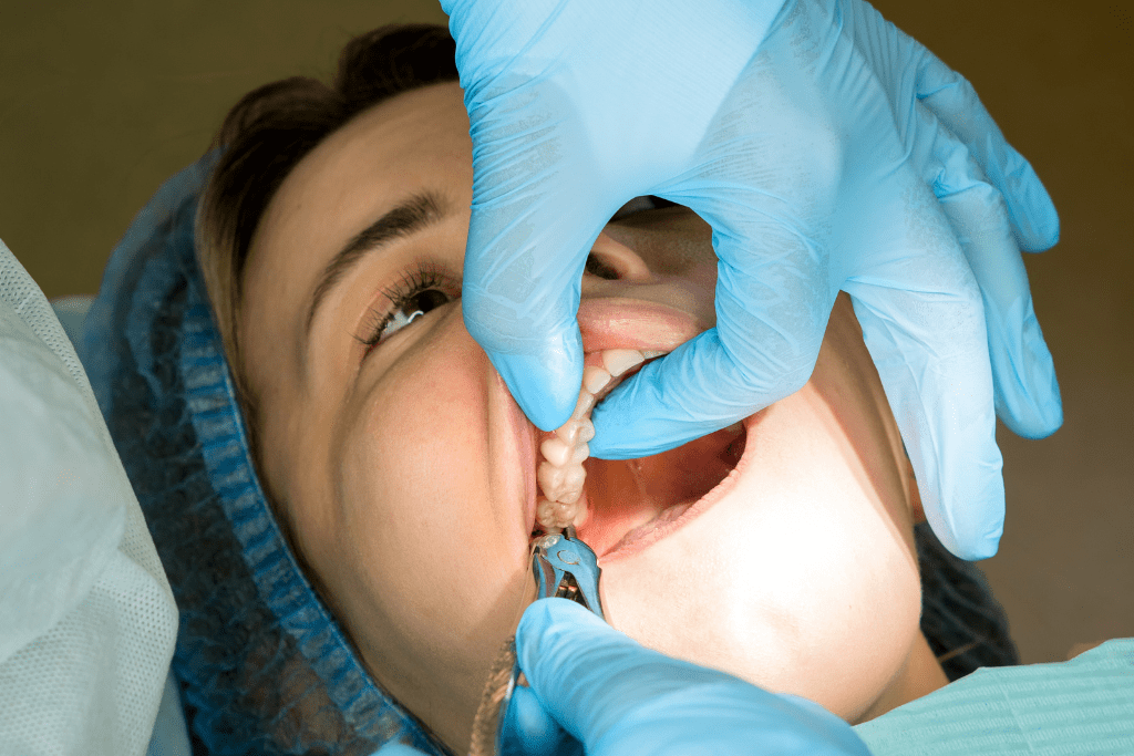 Dentist wearing blue gloves performing a tooth procedure on a patient on an upper back tooth.